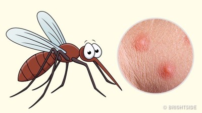  Trẻ bị muỗi đốt sưng to, nhiều nốt đỏ, bôi gì để nhanh khỏi? Giải pháp hiệu quả từ sản phẩm thảo dược